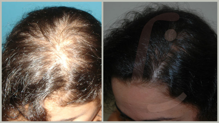 Transplante Capilar Feminino → Preços da Cirurgia, Fotos Antes e Depois